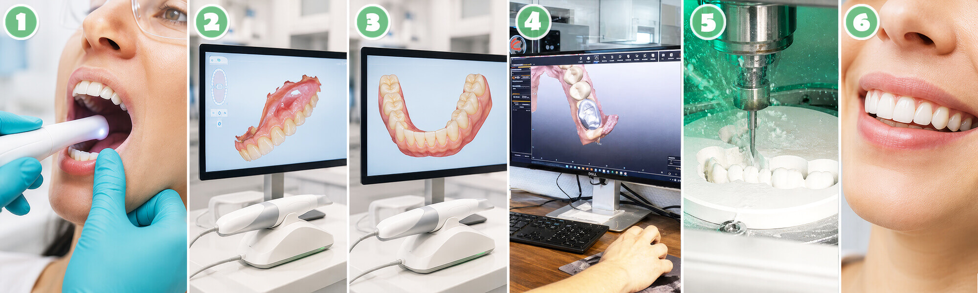 City Dental Labor - Digitale Abformung Ablauf in 6 Schritte